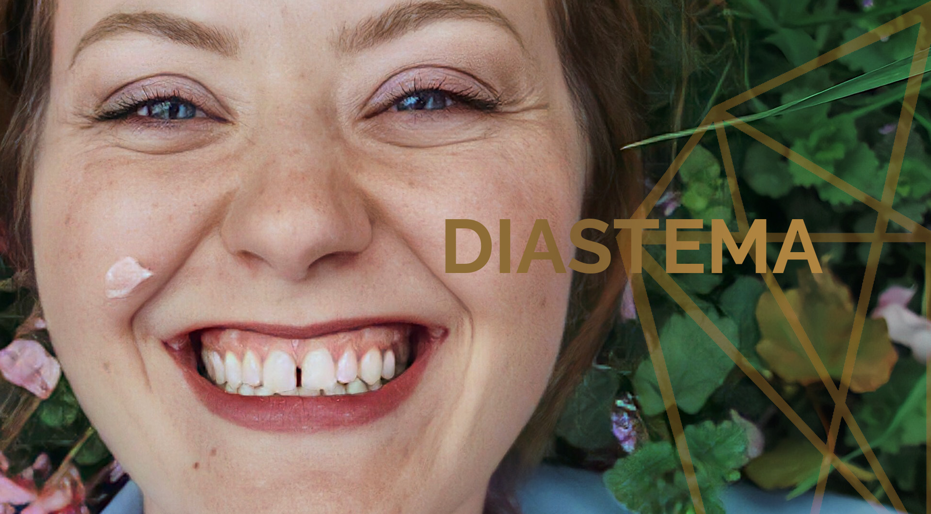 Diastema