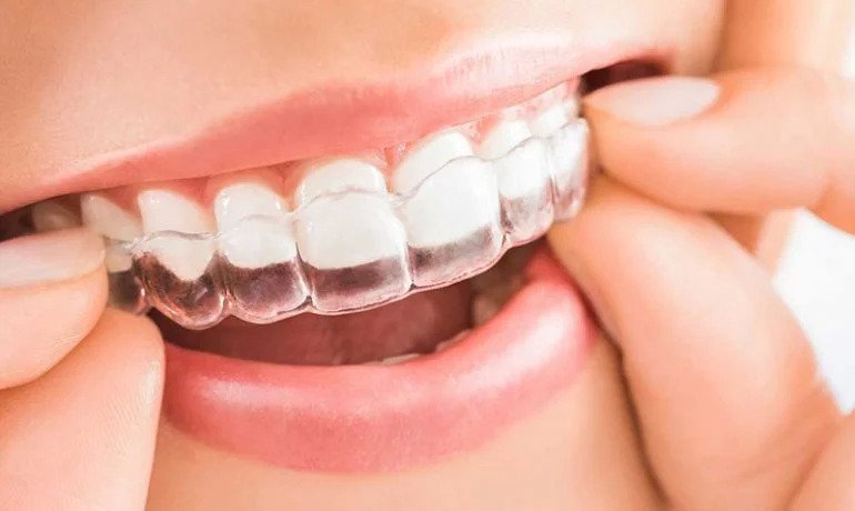 invisalign - niewidoczny aparat na zęby - aparat ortodontyczny