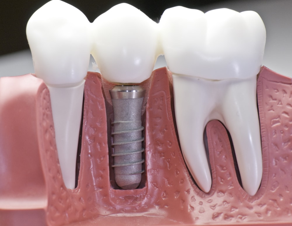 braki w uzębieniu - imlanty zębów