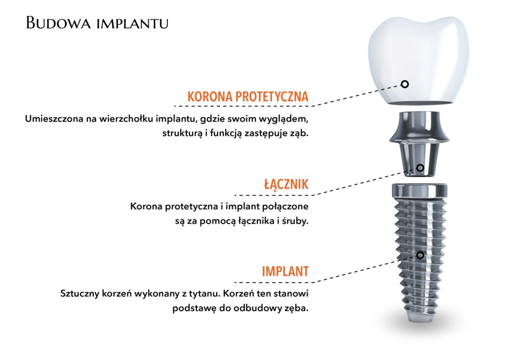 Implanty Poznań - Budowa Implantu