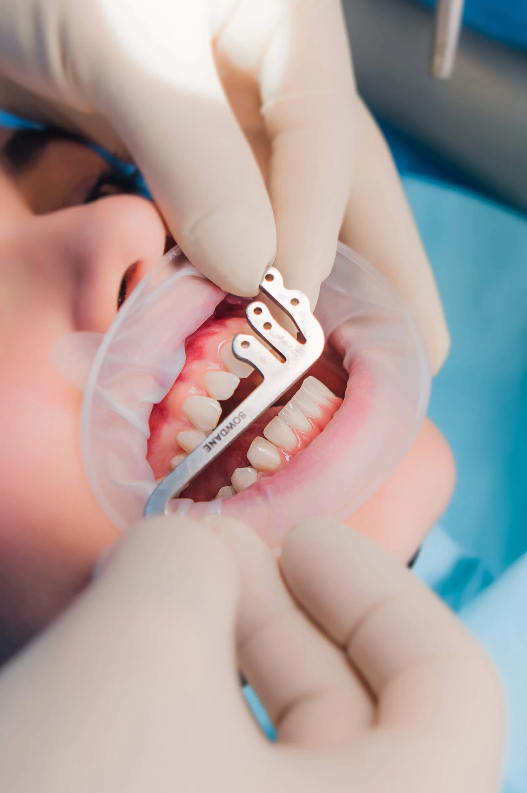 Implanty stomatologiczne jako doskonałe rozwiązanie w leczeniu bezzębia