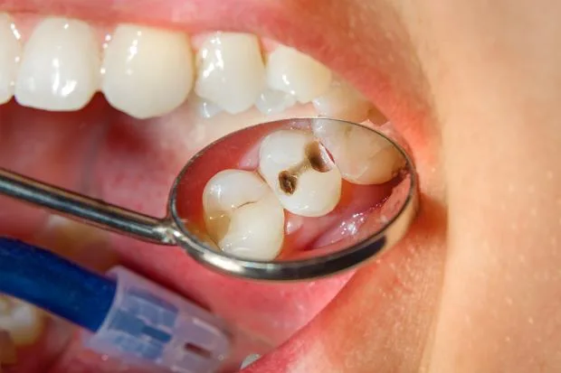 Próchnica zębów - leczenie Poznań