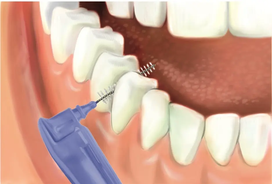 Jak wyczyścić przestrzeń między zębami