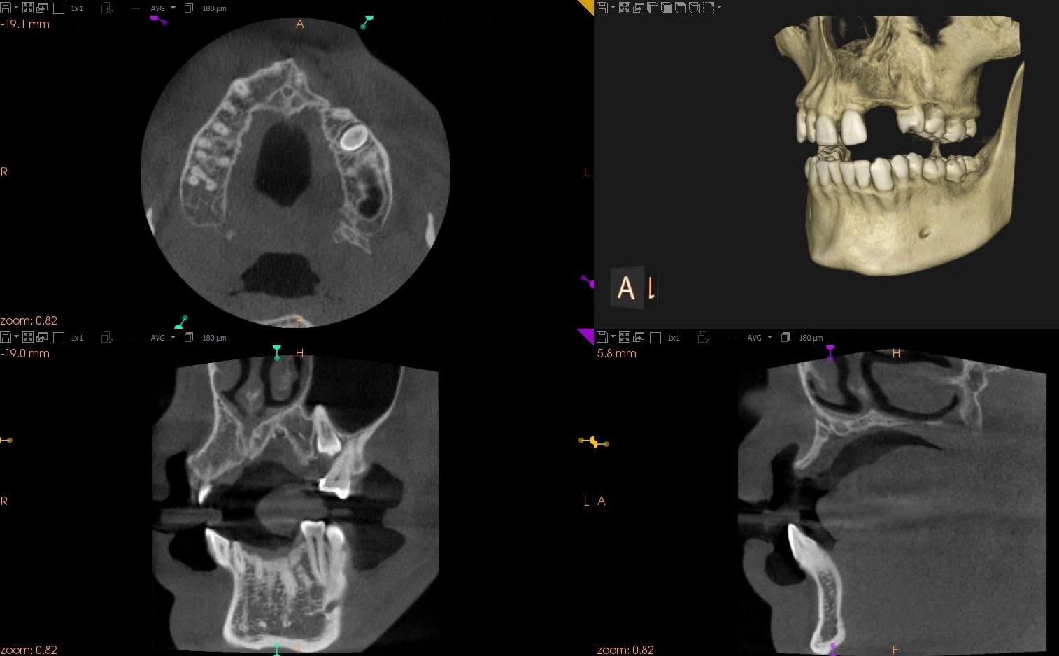Augmentacja kości przed implantacją