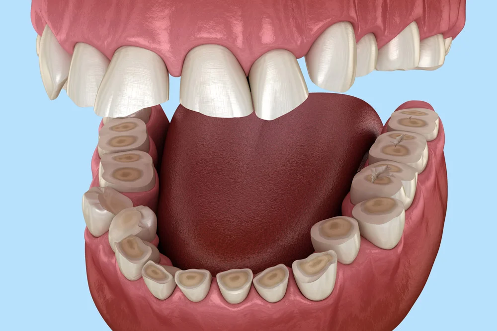 Starte zęby – przyczyny, skutki i możliwości odbudowy
