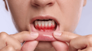 Czym objawia się przewlekłe zapalenie dziąseł?