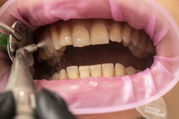 Closeup of teeth sandblasting, tartar cleaning and whitening