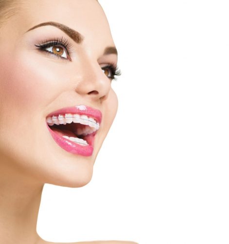 Beautiful woman smiling. Closeup ceramic braces on teeth