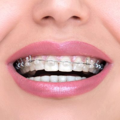 Closeup Ceramic and Metal Braces on Teeth. Self-ligating Brackets. Orthodontic Treatment. Woman Smiling Showing Dental Braces.