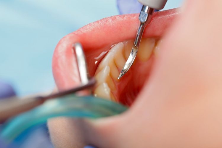 Dental calculus removing Close up of a dental calculus removing